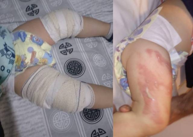 bebe-ficou-enfaixado-apos-queimadura-com-sopa-em-creche-de-limeira-side