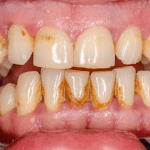 Saúde bucal: saiba como prevenir o tártaro e manter os dentes saudáveis